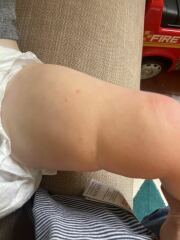 Is this chicken pox or viral rash?