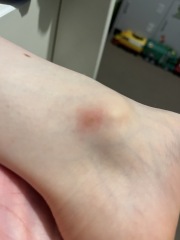 Infected insect bite?