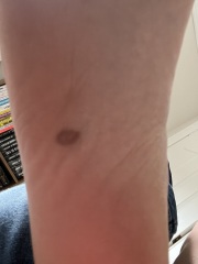 Moles / mark on sole of foot