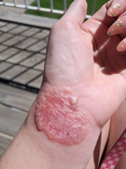 Contact Dermatitis? Please help!