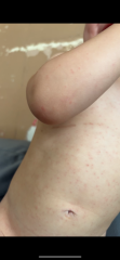rash appeared 4 days ago on my son