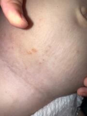 Chicken pox?
