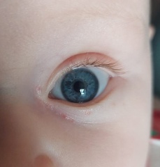 5 month old babies eye