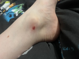 Infected insect bite?