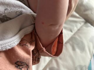Spots on baby…chickenpox?
