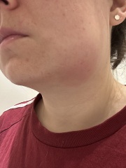 Should I go to A&E?