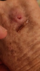 Do I need an antibiotic?