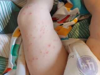 Is this chickenpox?