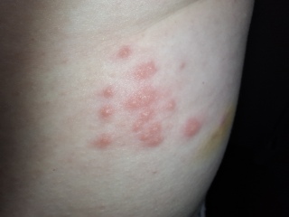 Weird burny rash
