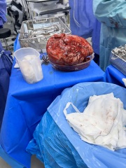 Fibroids during pregnancy