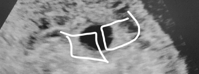 Scan confusion! 5 weeks scan