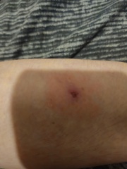 Identify my bites!