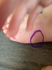 Insect Bite Diagnosis help!