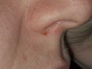 Coldsore or spots?