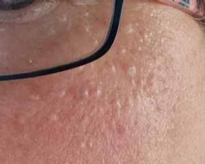 Help! Millia or syringomas or Sebaceous Hyperplasia