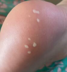 Are these just blisters?