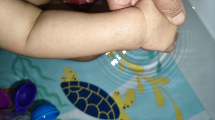 What is this rash please?