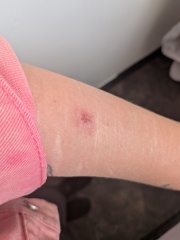 Bite. Infection, redness spreading? (Photo TMI)