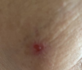 What is this sore on my Mum's face?