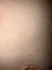 Chicken pox?