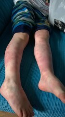 Help please - persistent low grade fevers and Petechiae two year old