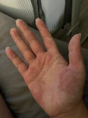 Sore hands