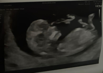 11 weeks 3 days boy or girl?