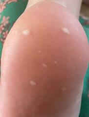 Are these just blisters?