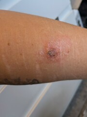 Bite. Infection, redness spreading? (Photo TMI)