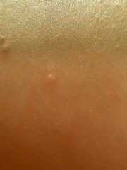 Chicken pox?