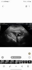 Baby gender 16 weeks scan
