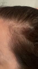 Hair loss with pic