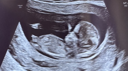 Umbilical cord or boy?