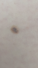 Is this mole a laser burn from hair removal or worse?!