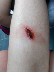 Any wound experts out there? (includes pic - warning!)