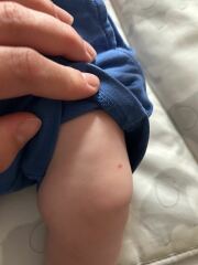 Spots on baby…chickenpox?