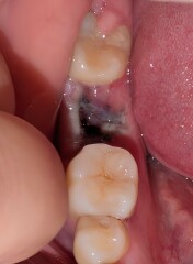 Tooth extraction healing