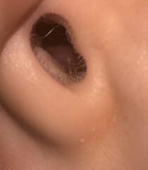 Nasal Polyps - 3 year old?