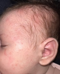 Rash/spots only on babies head and face