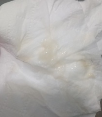 Is this discharge normal?