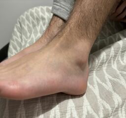 Foot injury