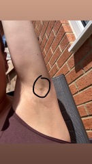 Worried sick about underarm lump/lymph node