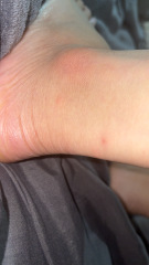Bed Bugs?