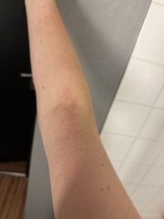 Itchy rash first trimester