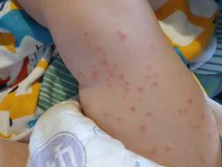 Is this chickenpox?