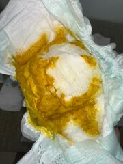 Persistent mucus in breastfed baby stool *photos*