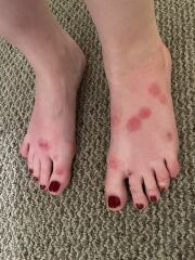 Identify my bites!
