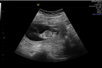 13.3 scan today 🤍