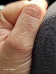 What are these on my hands and wrists?