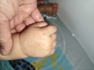 What is this rash please?